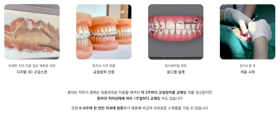 투명교정후기 의 장점, 단점, 종류 선택 (투명교정효과) 관련 이미지 3