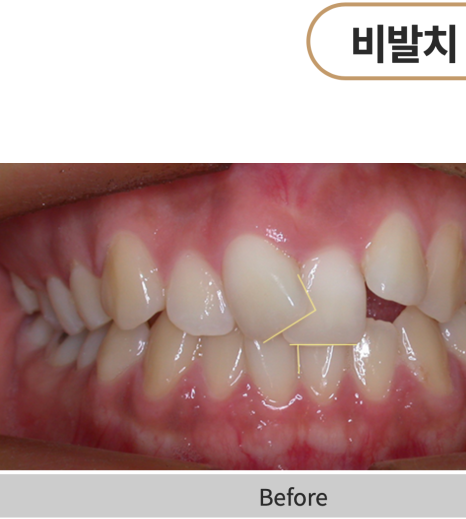 비발치교정 치료, 발치 없이 진행하는 과정 관련 이미지 11
