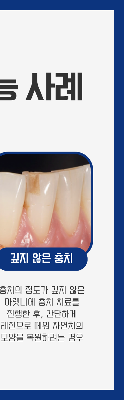 강남역 충치치료, 치아의 문제를 개선하는 과정? 관련 이미지 6