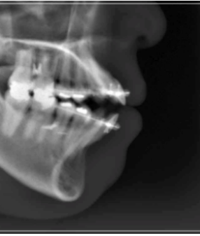입 안 다물어짐 수술 없이 해결하는 방법 관련 이미지 9