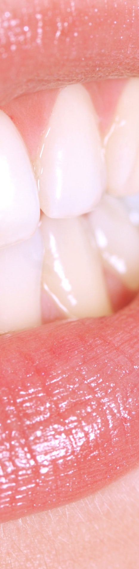 부정교합 교정치료, 비발치로 진행하려면? 관련 이미지 8