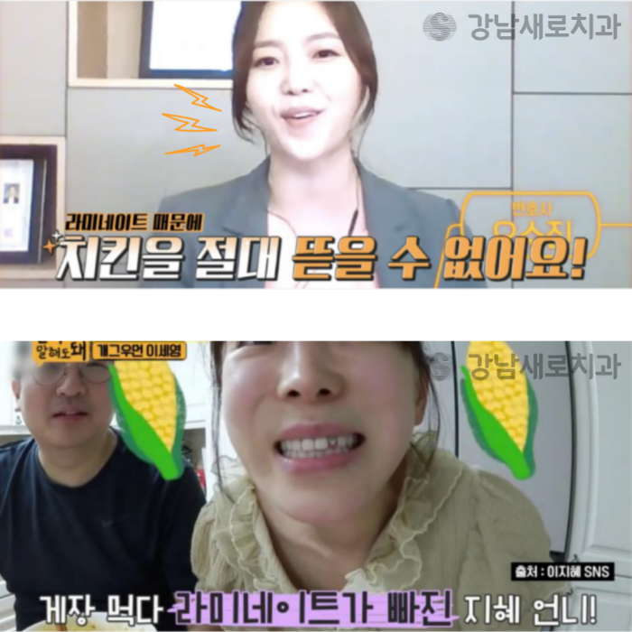 연예인라미네이트, 강남새로치과 에어네이트 관련 이미지 5