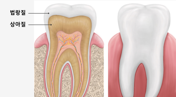 연예인라미네이트, 강남새로치과 에어네이트 관련 이미지 4