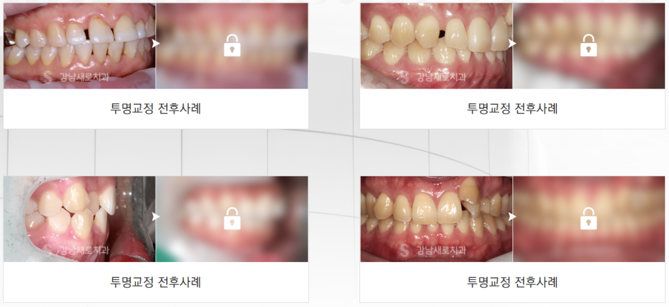 투명교정효과 없다면?! 투명교정 실패 막는 병원 선택 기준 관련 이미지 3