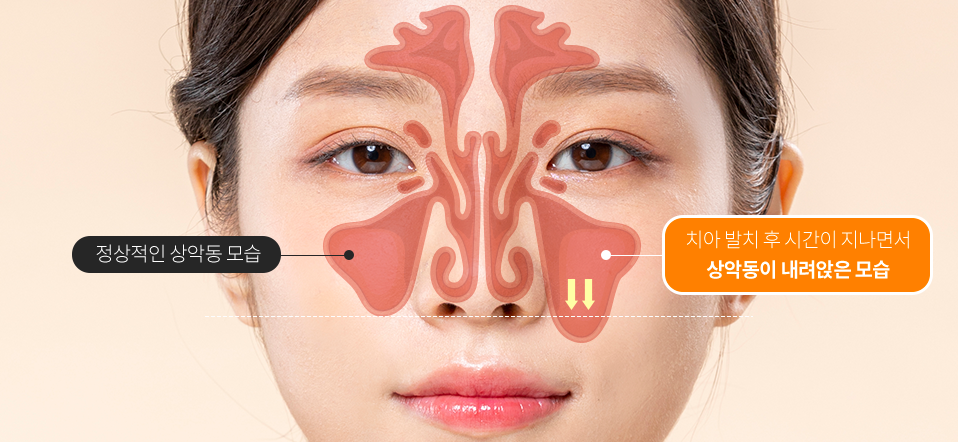 임플란트 안전한 결과를 위하여 [ 상악동거상술 ] [ 강남새로치과 ] 관련 이미지 1