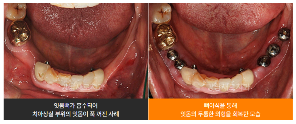 임플란트 성공률 수술 전 살펴봐야할 것 (임플란트주의사항) 관련 이미지 9
