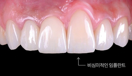 임플란트수술 후 부작용 생기지 않으려면 (임플란트부작용) 관련 이미지 7