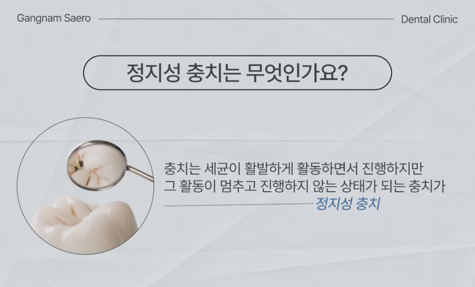 Is There a Cavity That Doesn’t Need Treatment? (Arrested Caries) image 3