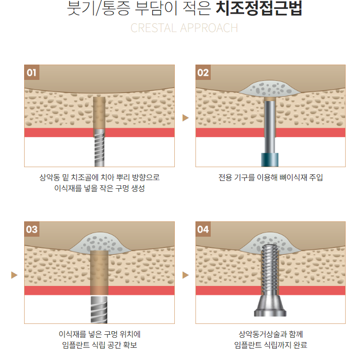 최소식립으로 최대효율 전체임플란트 (65세임플란트) 관련 이미지 2