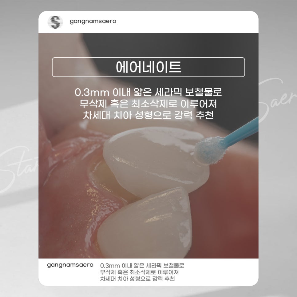 무삭제라미네이트 로 완성하는 가장 빠른 치아성형 (7DAYS치아성형) 관련 이미지 3