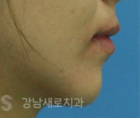 양악전 교정과 양악후 교정, 진행 방법의 차이를 알아보자. 관련 이미지 4