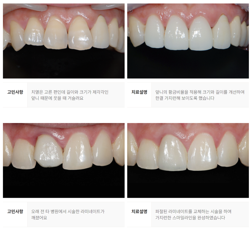 라미네이트 대체 시술 에어네이트 (치아 컴플렉스 해결 방법) [ 강남새로치과 ] 관련 이미지 8
