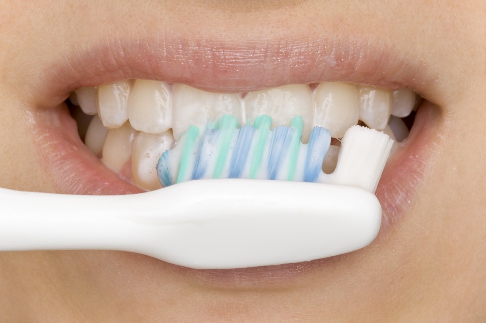 Orthodontic Side Effects (Relapse and Recurrence): Ways to Reduce Side Effects image 2