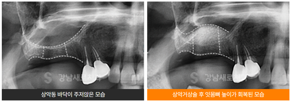 임플란트 안전한 결과를 위하여 [ 상악동거상술 ] [ 강남새로치과 ] 관련 이미지 3