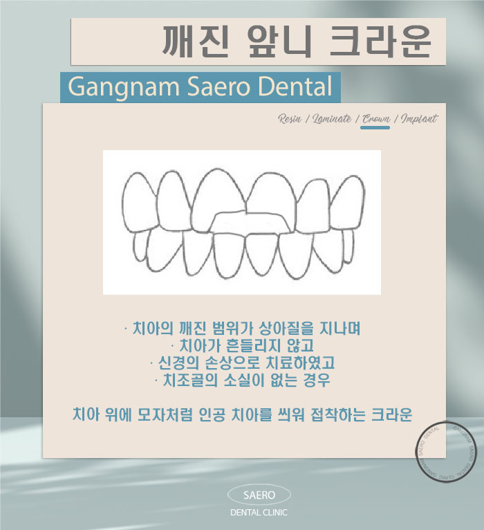 앞니가 깨졌어요! (깨진앞니 치료법) 관련 이미지 6