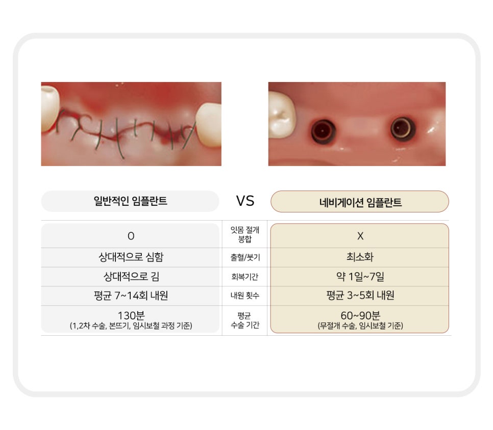 최소 통증으로 최대 효율 (임플란트통증) 관련 이미지 4