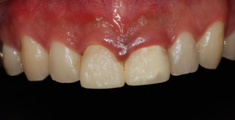 법랑질 삭제를 최소로 하는 헨리라미네이트 관련 이미지 12