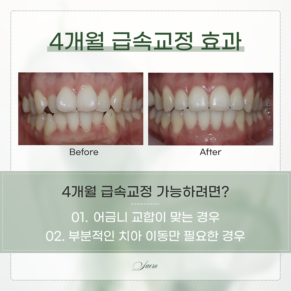 치아교정 가격이 어떻게 되나요? (치아교정비용) 관련 이미지 3