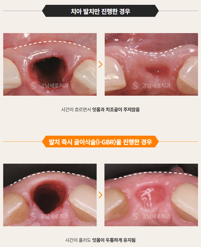 임플란트도 실패가 있습니다 (임플란트주의사항) 관련 이미지 7