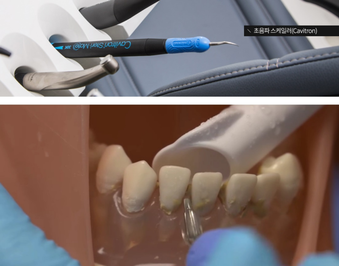 잇몸내려앉음이 발생하는 원인을 제대로 알아야 관련 이미지 9