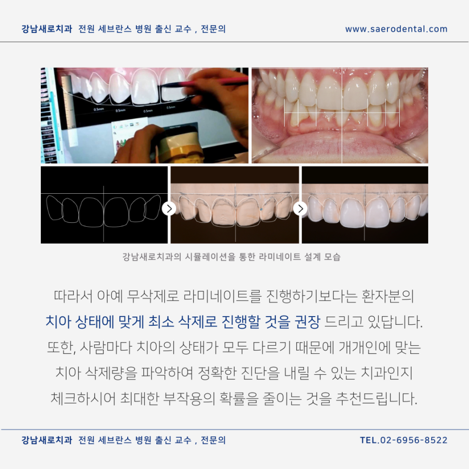 강남라미네이트, 무삭제가 최고? 전문의가 진실을 알려드립니다. 관련 이미지 9