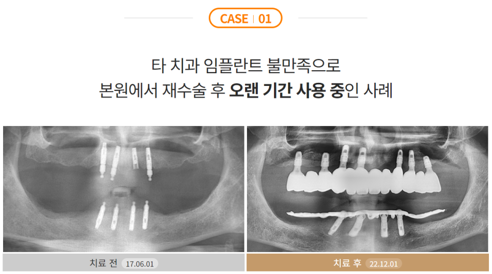 임플란트 잘하는 병원 (전체임플란트) 관련 이미지 5