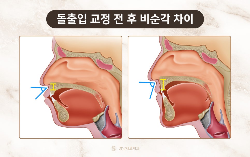 교정 부작용 자세히 알아보기 - 얼굴 변화 원리와 이유 [ 예방 및 대처 방법 ] [ 강남새로치과 ] 관련 이미지 5