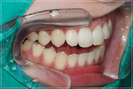 입안다물어짐 비수술로 해결이 가능하다면 관련 이미지 11