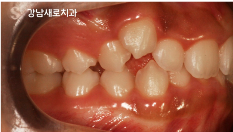 송곳니덧니교정, 방치하면 부작용이 발생한다? 관련 이미지 9