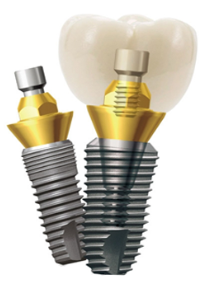 임플란트 종류 다시 알아보기 (4) 덴티움 관련 이미지 1