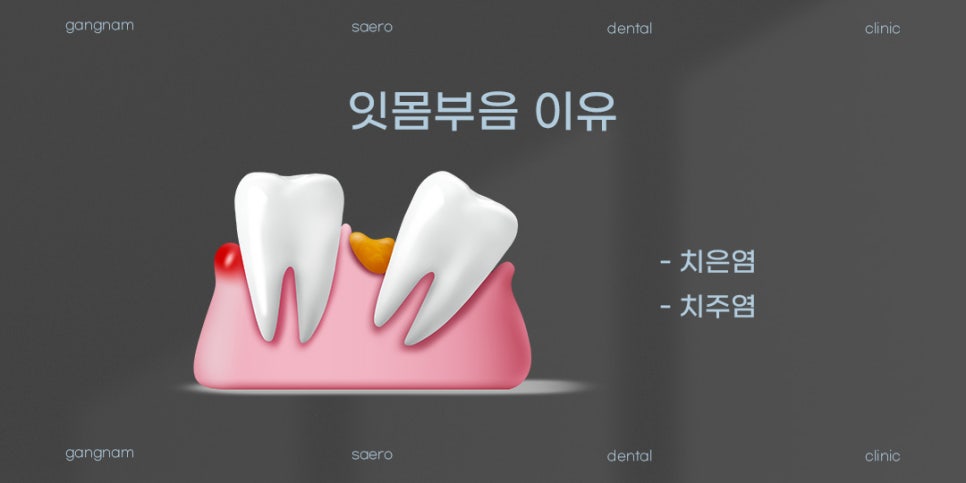 갑자기 잇몸이 부었다면? (잇몸부음원인 잇몸부음해결) 관련 이미지 2