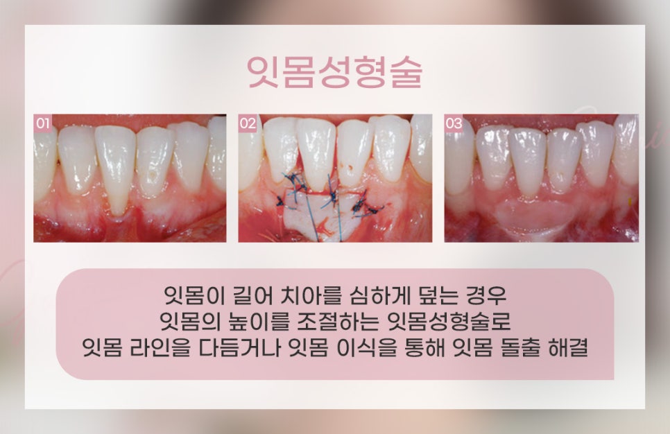 잇몸돌출교정 잇몸성형 수술 비수술 (잇몸돌출) 관련 이미지 4