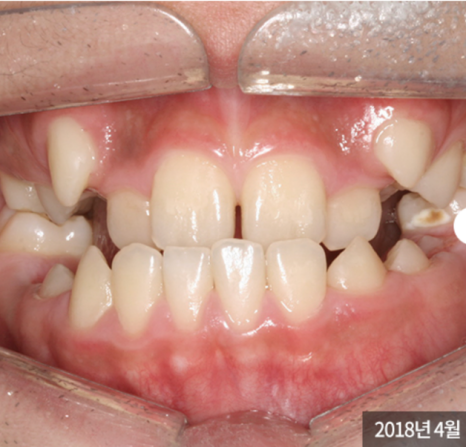 송곳니 덧니 교정없이 방치하면 발생하는 문제? 관련 이미지 2