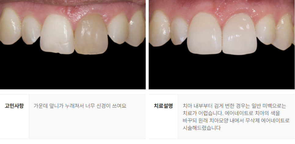 강남역 무삭제 라미네이트 (에어네이트) 관련 이미지 10