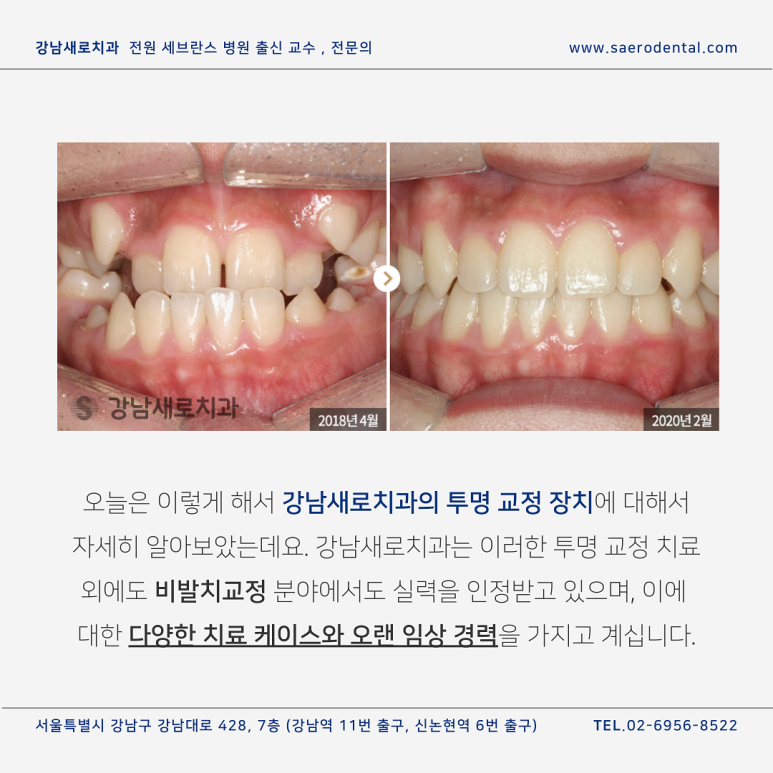 투명교정치료, 어떤 장치가 나와 잘 맞을까? 관련 이미지 7