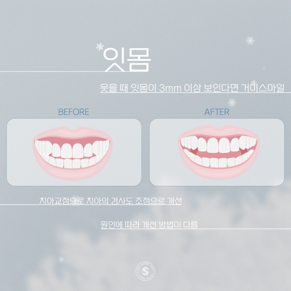 치과성형종류 부정교합 / 앞니 / 잇몸 비수술교정으로 예뻐지기 관련 이미지 6