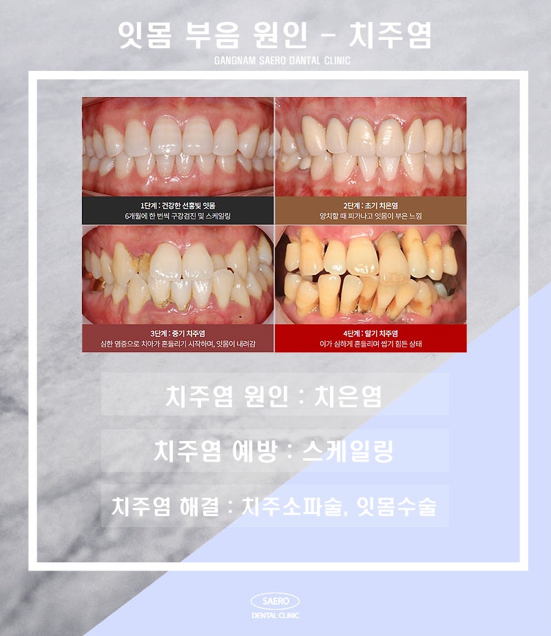 갑자기 잇몸 부을 때 정확한 원인과 올바른 해결 방법 (잇몸부음이유) 관련 이미지 3