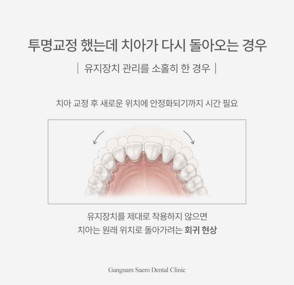 투명교정후회 안 하려면, 투명교정 시작 전 반드시 알아야 할 효과 회귀 재발 관련 이미지 4
