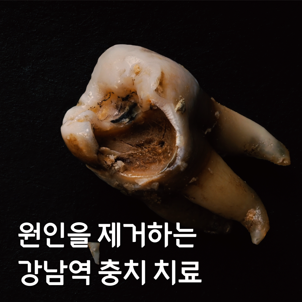 강남역충치치료 원인에 맞는 대처로 관련 이미지 1
