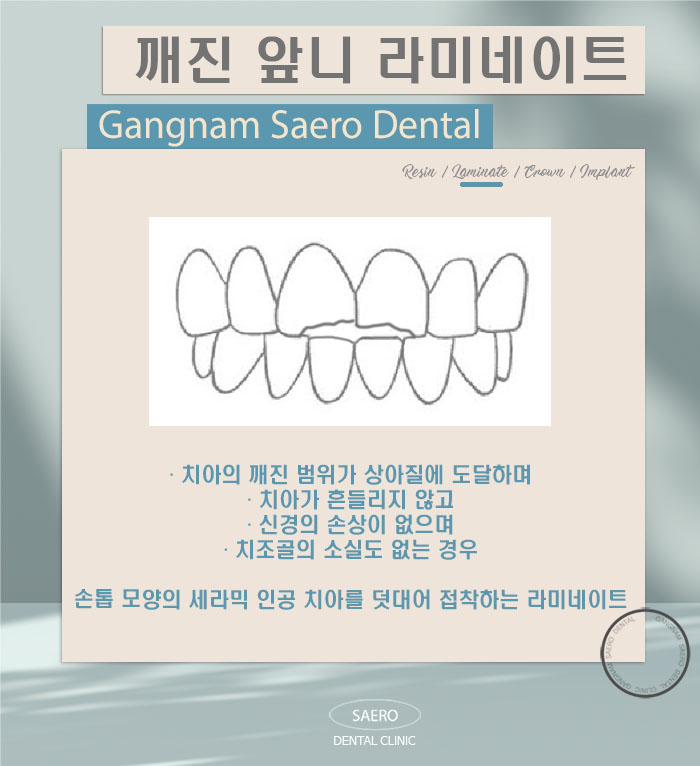 앞니가 깨졌어요! (깨진앞니 치료법) 관련 이미지 5