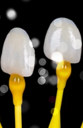 기안라미네이트 치아 손상 걱정없이 보다 안전한 진행 방법? 관련 이미지 12