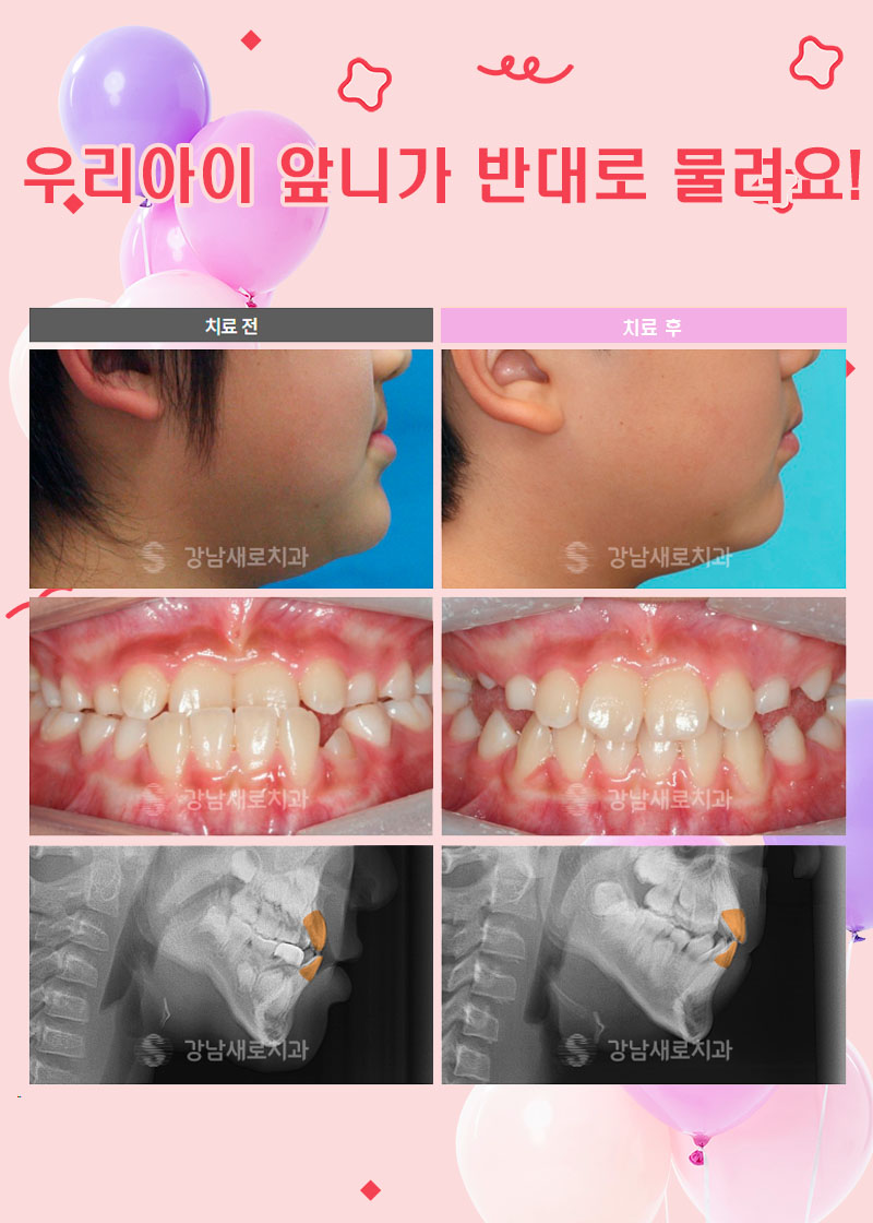우리아이 주걱턱 수술 없이 해결하려면 (어린이주걱턱교정) 관련 이미지 5