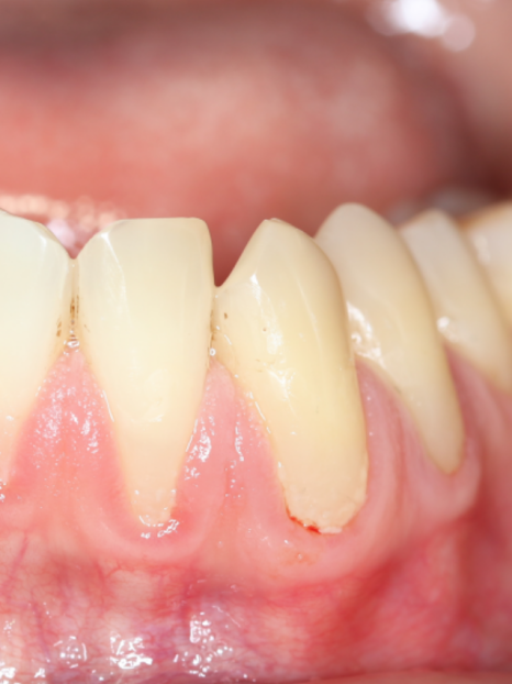 잇몸뼈 녹음이 발생하는 원인과 해결 방법 관련 이미지 3