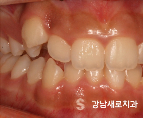 비발치교정 치료, 발치 없이 진행하는 과정 관련 이미지 8