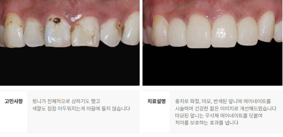 강남역 무삭제 라미네이트 (에어네이트) 관련 이미지 11