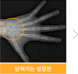 유아 주걱턱교정, 올바른 뼈 성장을 위한 방법 관련 이미지 13