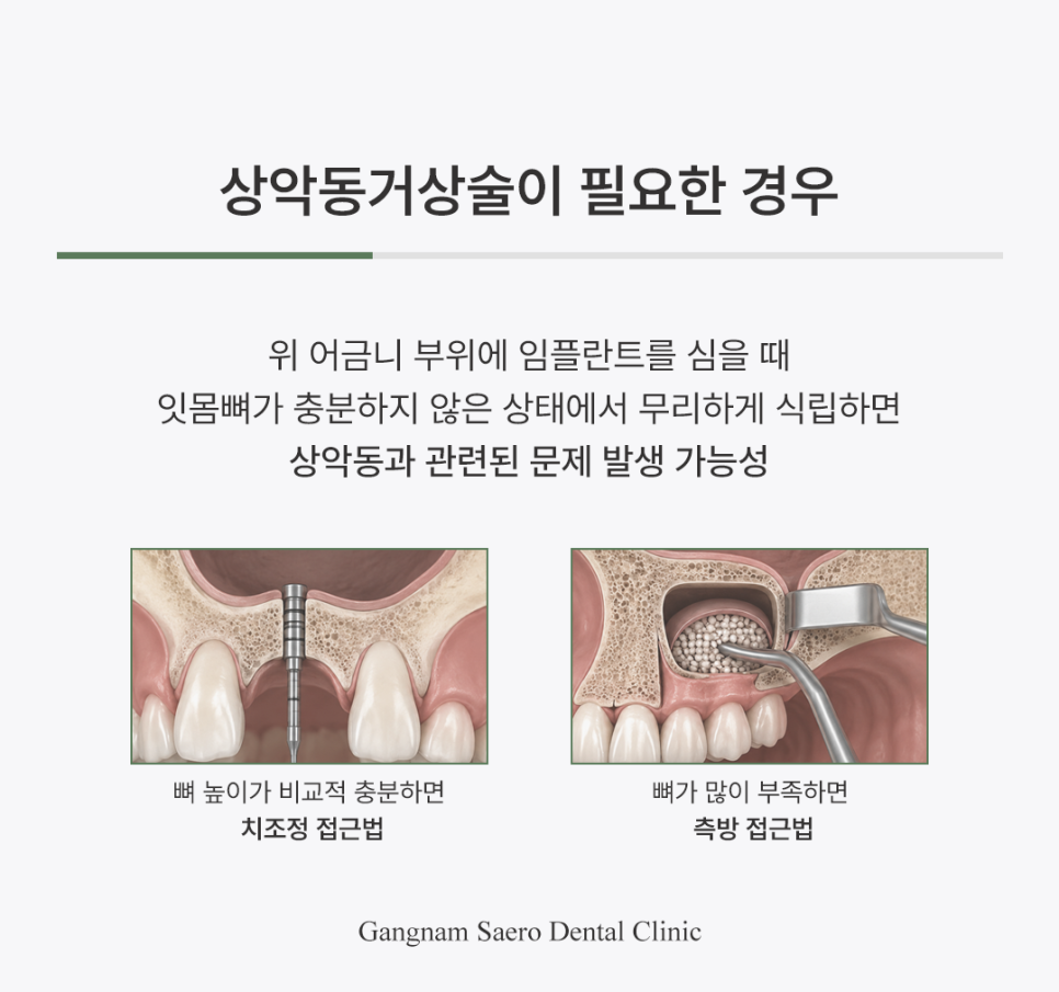 65세이상임플란트, 안전한 임플란트 수술 방법 관련 이미지 3