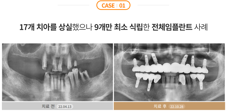 임플란트 잘하는 병원 (전체임플란트) 관련 이미지 3