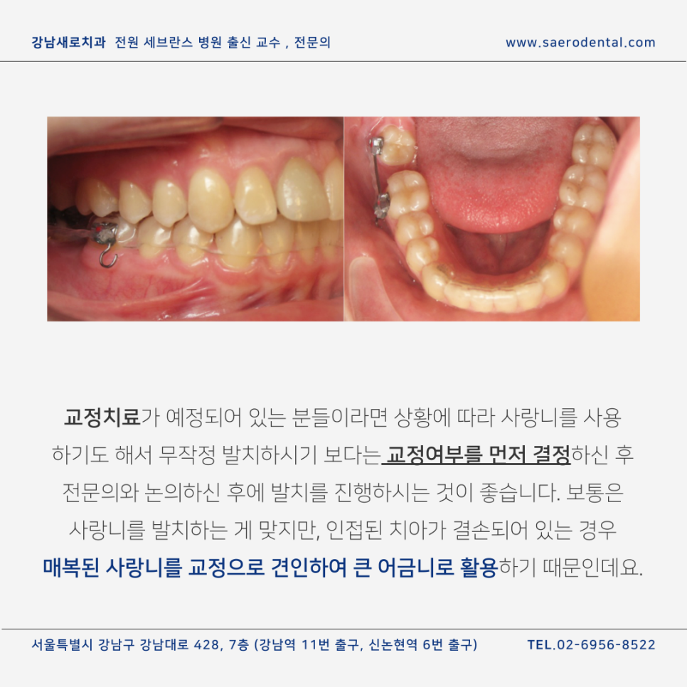 강남사랑니치과, 매복사랑니를 더욱 효율적으로 발치하려면 관련 이미지 10