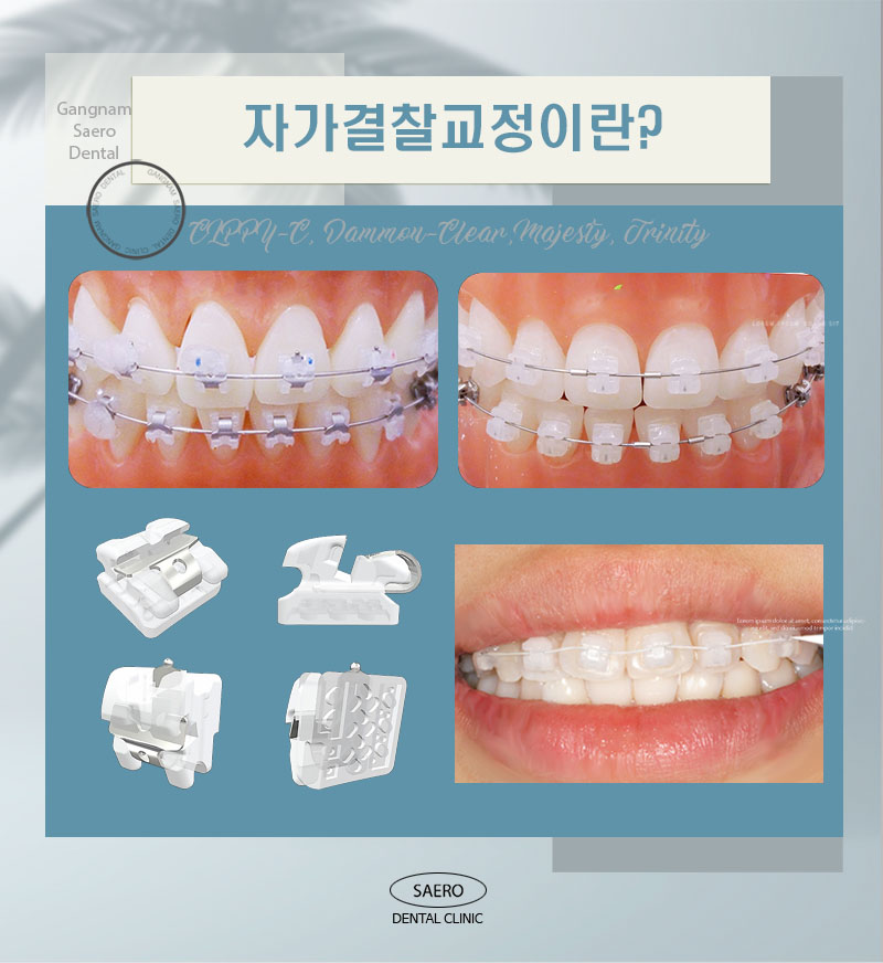 자가결찰교정과 클리피씨의 차이? (자가결찰교정 종류) 관련 이미지 2